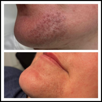 Laser Hair Removal 5