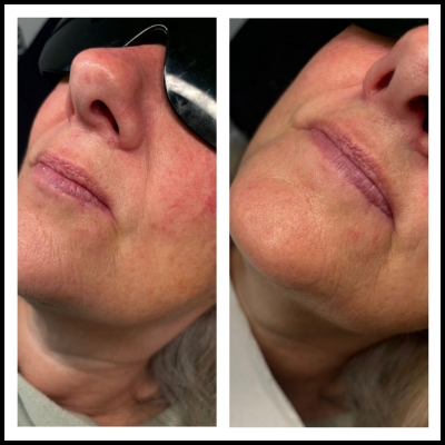 Laser Hair Removal 8